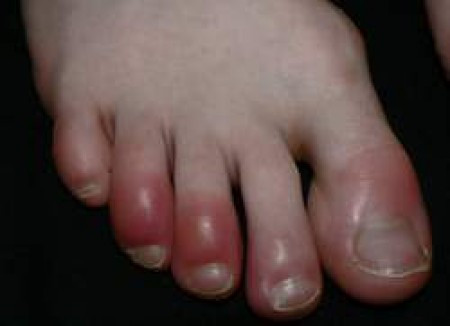  Cước chân tay là bệnh thường gặp vào mùa đông. Do thời tiết quá lạnh khiên cho các ngón chân, ngón tay chúng ta bị đỏ hắt lên, rất ngứa, rát và cảm thấy khó chịu và đấy chính là hiện tượng bị cước.