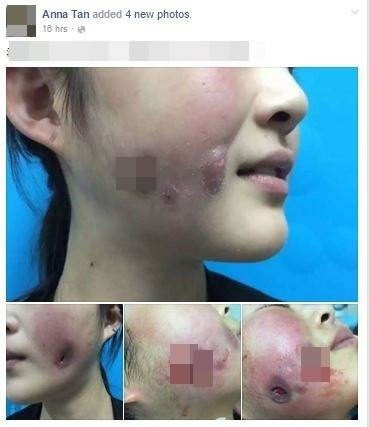 Bien dang khuon mat chi vi phau thuat tham my rom-Hinh-2