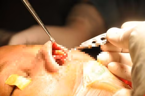 Hai hung silicon bom vao mui nhiem trung cung nhu da-Hinh-3