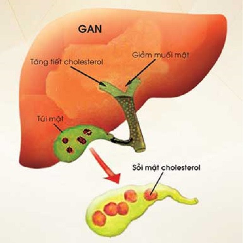 Hau qua cua roi loan chuyen hoa Lipid mau-Hinh-6