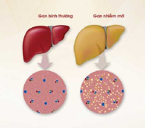 Hau qua cua roi loan chuyen hoa Lipid mau-Hinh-5