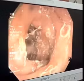 Hàng trăm con giun "trú ngụ" trong đường tiêu hóa người phụ nữ Hang tram con giun