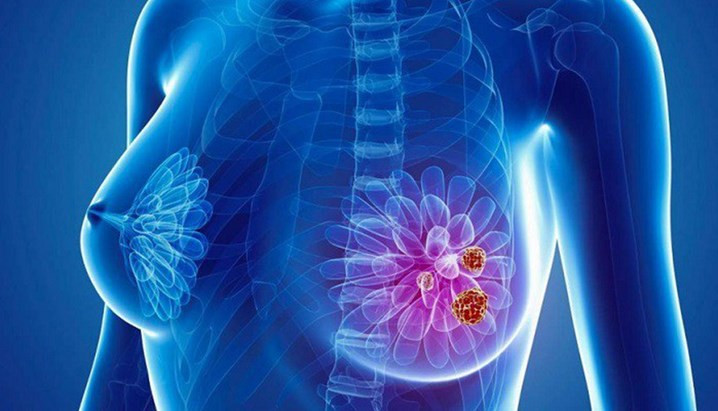 Ung thư vú nếu được phát hiện, điều trị kịp thời sẽ cải thiện đáng kể chất lượng sống cho người bệnh, tránh các hệ lụy đáng tiếc. Ảnh minh họa