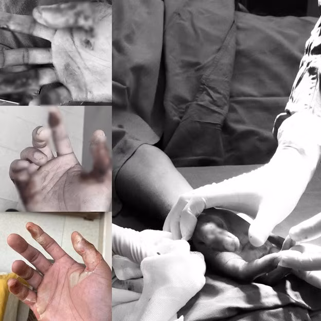 Nhiem trung nang vi boi cao sim chua bong bo xe may