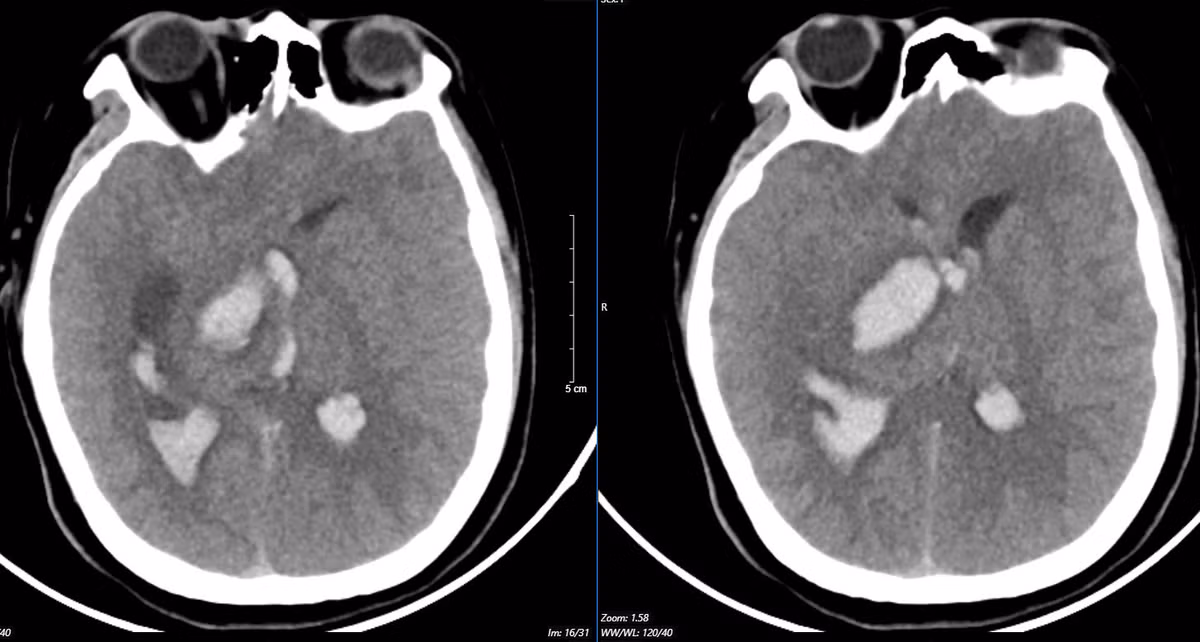 Nhiều người trẻ tử vong sau khi xuất hiện cơn đau đầu đột ngột Nhieu nguoi tre tu vong sau khi xuat hien con dau dau dot ngot