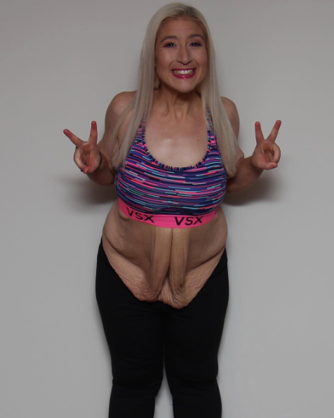 Jacqueline chia sẻ, trên người cô khi ấy có tới những 15 kg da thừa...