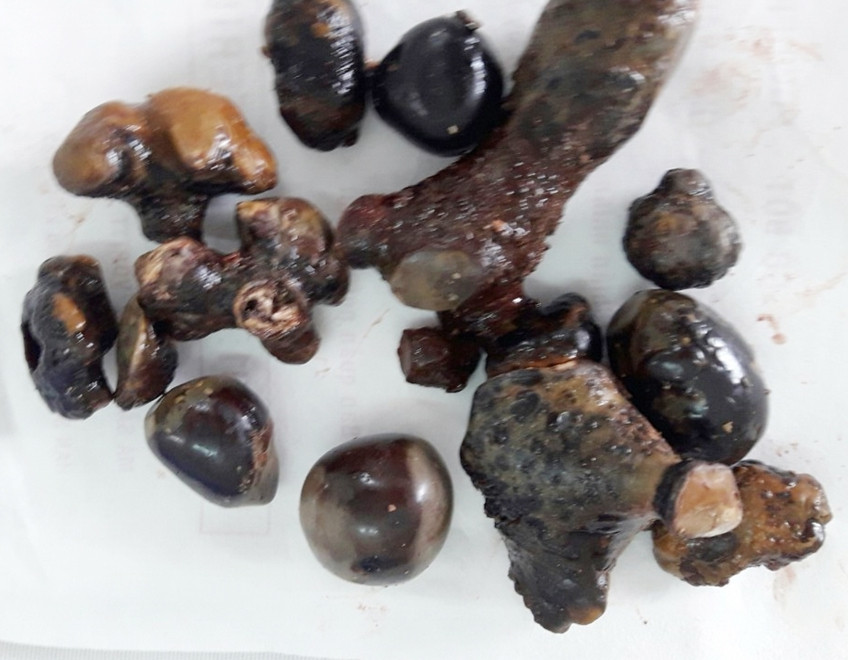 Sốc với "đống" sỏi san hô mọc nhánh trong thận người đàn ông Soc voi