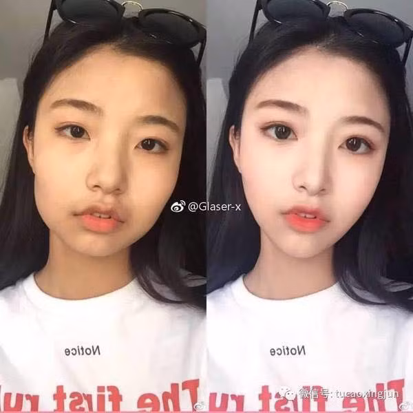 Gương mặt U-line thành V-line sau nhiều nỗ lực chỉnh sửa.