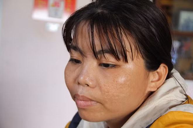 Câu chuyện của chị Trần Thị Bình (34 tuổi, ở thôn 3, xã Hiệp Thuận, H.Hiệp Đức, Quảng Nam) chỉ uống nước đá để cẩm hơi, hễ ăn gì vào bụng phình to ra, nôn mửa và khó thở trong suốt 7 năm qua cũng khiến nhiều người cảm thấy kỳ lạ.