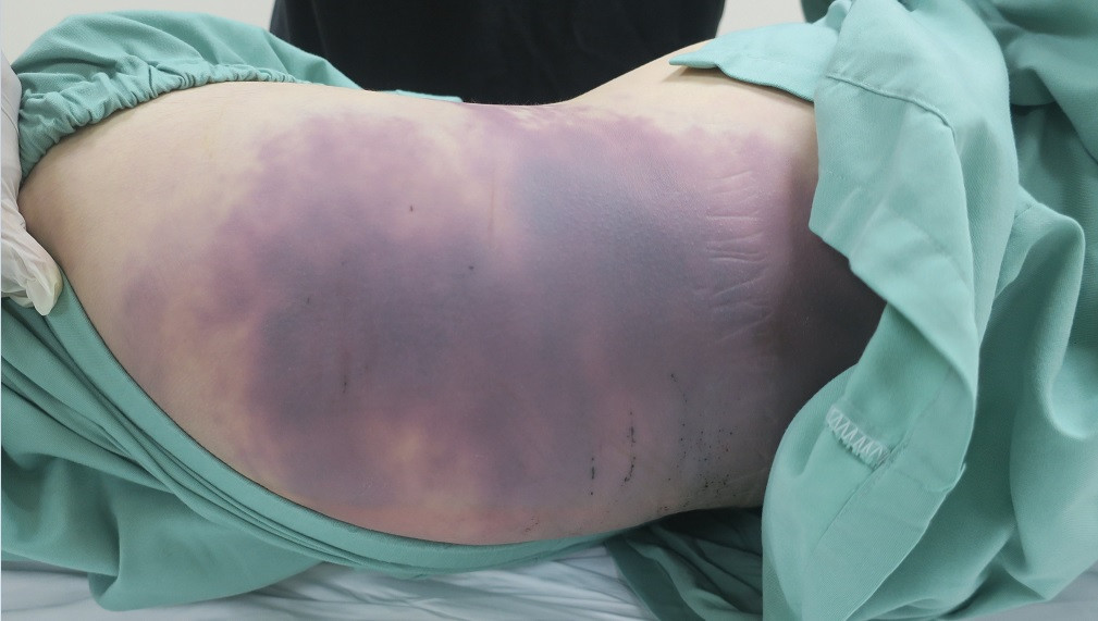 Theo Công an quận Bình Thạnh, kết quả pháp y xác định bé gái bị phù phổi cấp và trên người có nhiều vết bầm. Công an xác định Trang có dấu hiệu bạo hành bé V.A nên ra quyết định bắt khẩn cấp. Đến nay, cơ quan điều tra xác định Trang có dấu hiệu phạm tội nên khởi tố, bắt tạm giam.