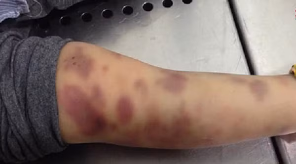 Sau khi nhận được tin báo, Công an quận Bình Thạnh đã khẩn trương điều tra làm rõ nguyên nhân vụ việc trên. Qua điều tra ban đầu xác định, anh T và Nguyễn Võ Quỳnh Trang có quan hệ tình cảm, sống chung như vợ chồng từ tháng 6/2020 ở tòa nhà Saigon Pearl (quận Bình Thạnh). Vào khoảng 14h00’ ngày 22/12/2021, Trang hướng dẫn cháu A học bài; cháu A chậm tiếp thu bài nên Trang lớn tiếng la mắng và dùng 01 cây gỗ đánh cháu A. Sau đó, Trang phát hiện cháu A bị nôn ói nên chạy đến đỡ cháu dậy, gọi điện thoại anh T về đưa cháu vào Bệnh viện Vinmec cấp cứu nhưng cháu A đã tử vong sau đó.