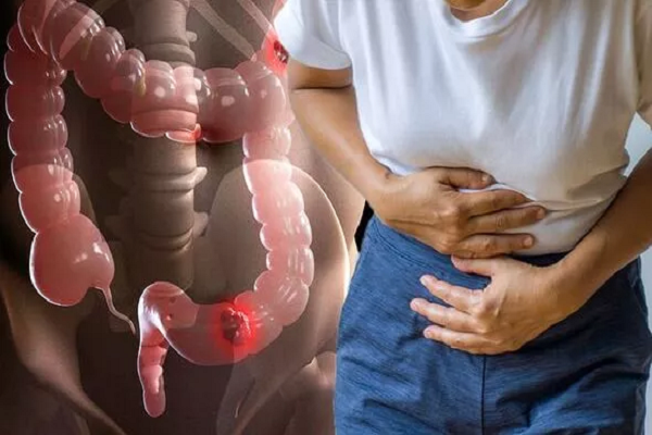 Co the xuat hien 3 trieu chung nay, coi chung ung thu ruot