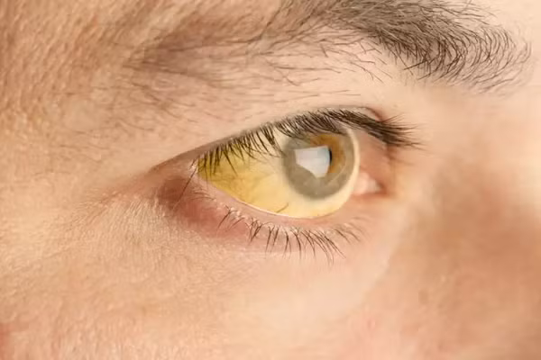 Dấu hiệu cảnh báo gan của bạn đang “kêu cứu” Dau hieu canh bao gan cua ban dang “keu cuu”