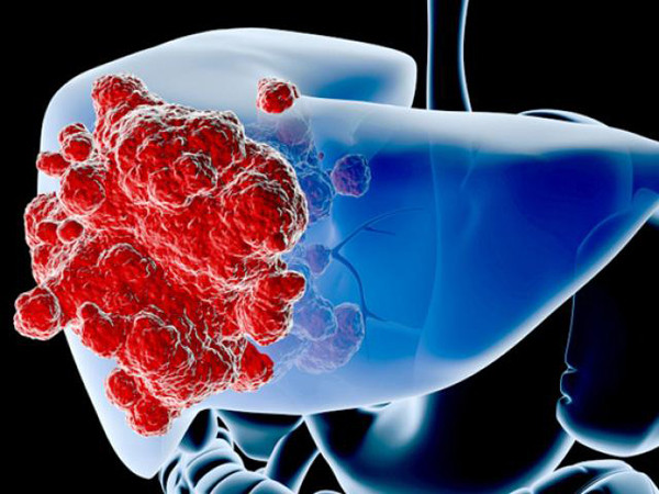 Ngoài ung thư vòm họng, lượng lớn formaldehyde đi vào cơ thể có khả năng gây ung thư máu. Điều này giải thích những người làm việc trong môi trường tiếp xúc với formaldehyde như xưởng giày, xưởng dầu, xưởng hóa chất...có xác suất mắc ung thư máu cao hơn.
