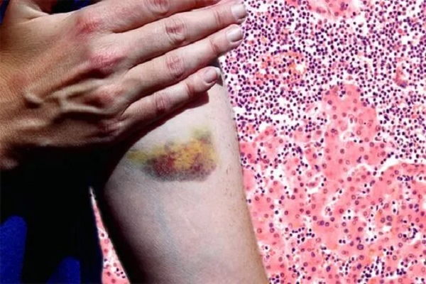 Vết bầm xuất hiện ở vị trí bất thường, coi chừng ung thư Vet bam xuat hien o vi tri bat thuong, coi chung ung thu