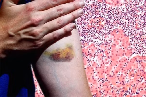 Vết bầm xuất hiện ở vị trí bất thường, coi chừng ung thư Vet bam xuat hien o vi tri bat thuong, coi chung ung thu