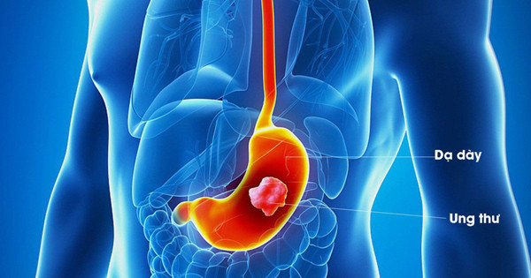 Để ngăn ngừa nguy cơ ung thư dạ dày, trước hết nên phát hiện và điều trị sớm các bệnh dạ dày phổ biến, tránh tình trạng bệnh tiến triển xấu, hình thành tế bào ung thư. Ngoài ra, nam giới nên duy trì chế độ ăn nhạt, tránh đồ hun khói, thực phẩm bảo quản, rượu bia, thuốc lá...