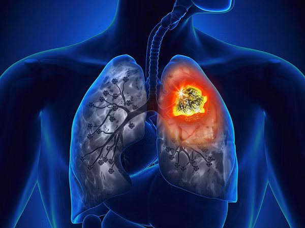 Ung thư phổi. Theo trang 39Health, tỷ lệ nam giới mắc ung thư phổi cao hơn phụ nữ. Tình trạng này bắt nguồn từ thói quen hút thuốc lá. Được biết, khói thuốc lá chứa hơn 7.000 hóa chất, trong đó có 69 chất gây ung thư. Khi đi vào cơ thể, những chất độc hại sẽ tác động, làm tăng nguy cơ ung thư phổi.