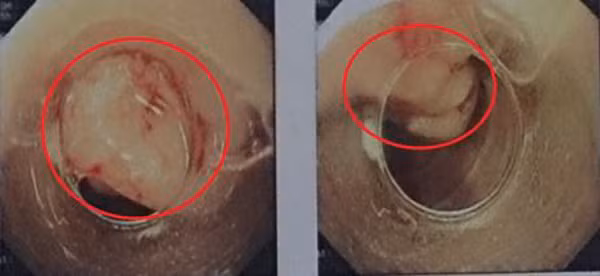 U tá tràng kích thước khoảng 3cm trong lòng tá tràng