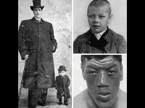 Trong thời gian đó, sức khỏe của Rainer bắt đầu xuống dốc. Ông được các bác sĩ chẩn đoán mắc bệnh vẹo xương sống. Về sau, người ta còn phát hiện người khổng lồ này mắc chứng bệnh To đầu chi, một bệnh khá hiếm.