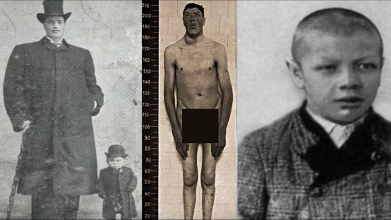 Chứng vẹo xương sống của Rainer ngày càng nghiêm trọng hơn. Người khổng lồ mất thị giác ở mắt phải và mất khả năng nghe ở tai trái.