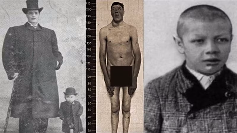 Chứng vẹo xương sống của Rainer ngày càng nghiêm trọng hơn. Người khổng lồ mất thị giác ở mắt phải và mất khả năng nghe ở tai trái.