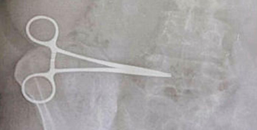 Sieu am kham lai, bac si het hon vi quen keo trong bung benh nhan