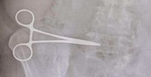 Sieu am kham lai, bac si het hon vi quen keo trong bung benh nhan