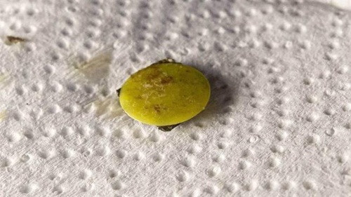 Dau mui suot 37 nam, di kham phat hien dieu kinh di-Hinh-3