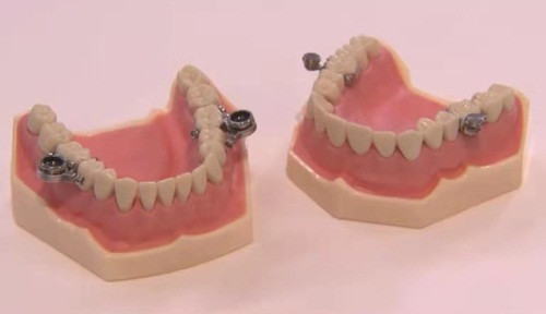 Phuong phap giam can cuc gat: Lap bu long vao rang de khoa mieng-Hinh-2