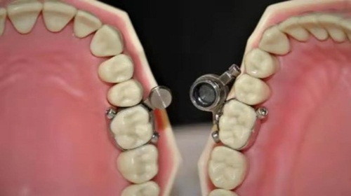 Phuong phap giam can cuc gat: Lap bu long vao rang de khoa mieng-Hinh-3