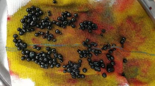 Nghien ga ran, thieu nien 15 tuoi co hon 100 vien “ngoc trai den” trong bung