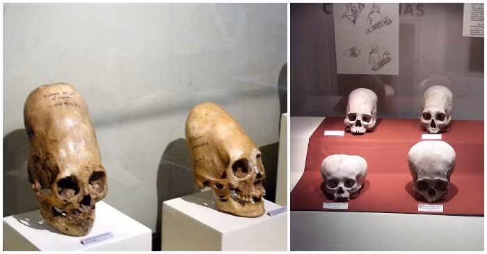 Trong thời gian đó, người Peru thường làm biến dạng hộp sọ nhằm thể hiện địa vị cao quý.