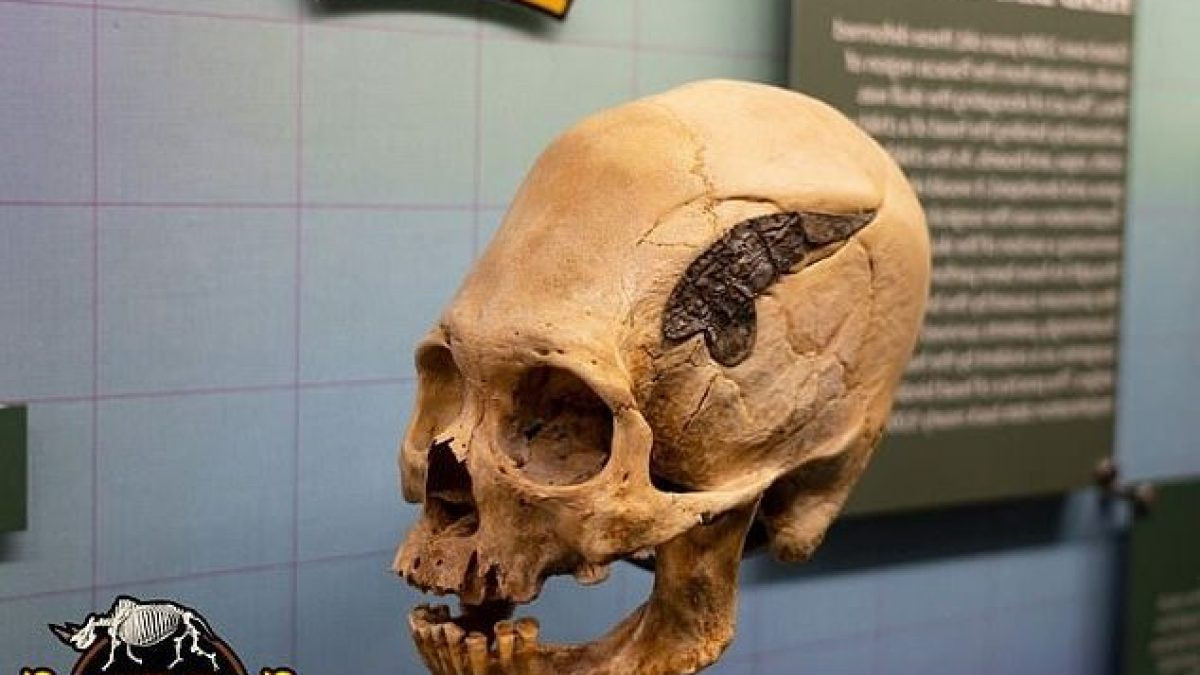 Ca phẫu thuật thành công khi chiến binh trên sống sót sau ca mổ hộp sọ phức tạp.