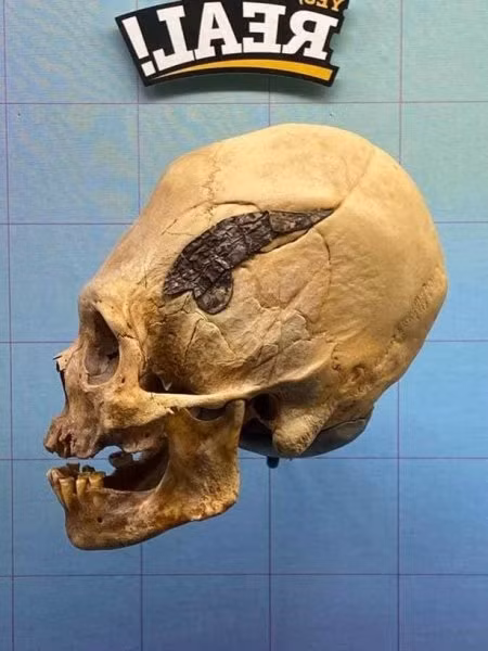 Đặc biệt, thầy thuốc thực hiện ca phẫu thuật não trên mà không sử dụng các kỹ thuật vô trùng hay gây mê như ngày nay.