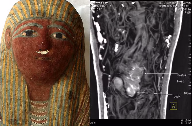 Dù vậy, một số chuyên gia đưa ra giả thuyết người phụ nữ có thể đã gặp một số vấn đề về sức khỏe trong quá trình mang thai. Điều này khiến bà tử vong trong thời gian thai kỳ.