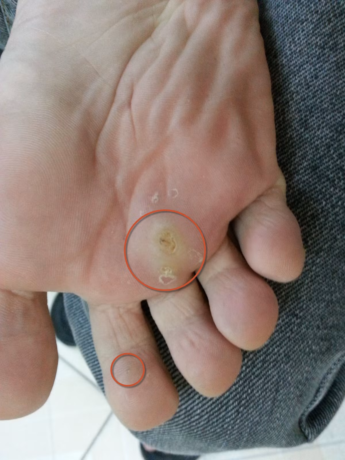 Mụn cóc mọc ở lòng bàn chân thường sẽ gây đau đớn khó chịu cho bạn.