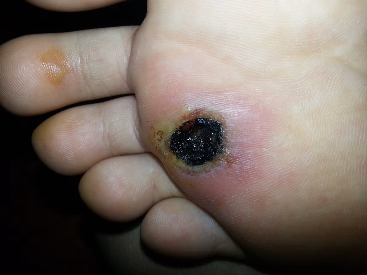 Mụn cóc sinh ra là do một loại virus xâm nhập vào vùng da chân thông qua vết nứt trên da.