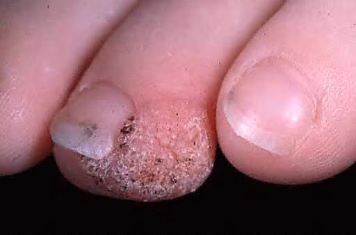 Khi bạn bị mọc mụn cóc ở lòng bàn chân thì sau một thời gian nó thường lây lan sang các khu vực khác của bàn chân, tăng dần kích thước mụn và gây đau đớn.