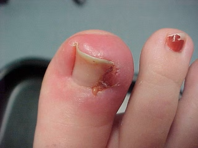Những chiếc móng chân mọc ngược quặp vào trong có thể khiến mé móng chân bị sưng lên mưng mủ.