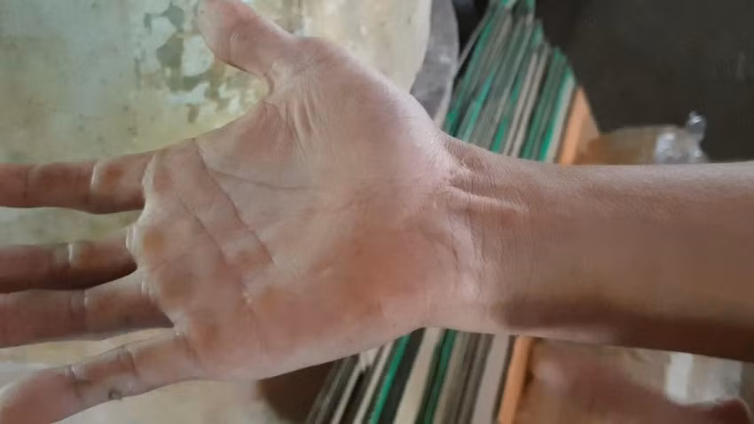 Theo lời kể của anh Nguyễn Tiến Dũng, con khỉ đực được gia đình nuôi khoảng 8 năm nay. Cách đây 3 năm, anh bị nó cắn do bất cẩn cho lúc cho ăn. Vì vậy, anh phải khâu hơn 10 mũi và sau 1 tháng mới bình phục.