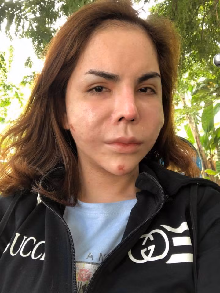 Đang nhận được nhiều phản hồi tích cực nhờ gương mặt ngày càng xinh đẹp, thân hình quyến rũ và gu thời trang ấn tượng thì mới đây, "hot girl" Linda khiến những người theo dõi mình không khỏi xôn xao bàn tán khi quyết định công khai gương mặt biến dạng kinh hoàng của mình.