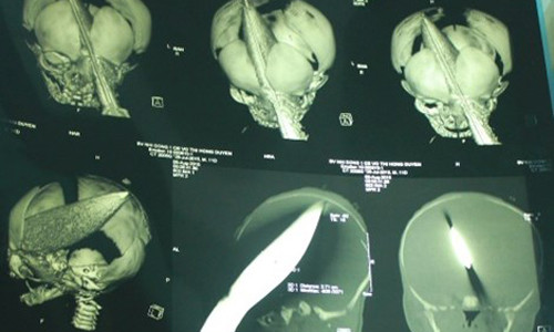 Be trai bi dam xuyen dau: Da bat duoc nghi pham