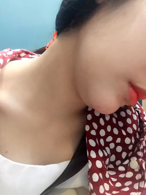 Do bị tiêm thêm silicon lẫn với chất độn filler, nên sau một thời gian ngắn, mặt và cằm của cô bạn 9X Mai Anh bị chảy sệ, dài ra dị thường. Thậm chí silicon còn dồn đọng sang bên má phải khiến khuôn mặt Mai Anh bị lệch, xuất hiện nọng cằm xấu xí và khiến cô bị mất luôn má lúm đồng tiền vốn có.