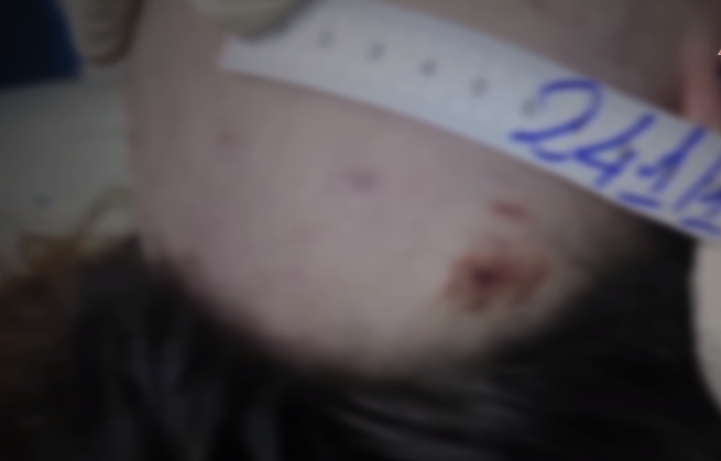 Khám nghiệm tử thi chỉ có một số vết bẩn vàng quyệt phần khửu tay, khửu chân có một vài vết xây xát nhẹ, từ đó cơ quan chức năng nhận định nạn nhân bị ngã xuống đường xong những dấu vết này không gây tử vong cho nạn nhân. Quan trọng là phần dấu vết ở đỉnh đầu phía sau có khối nề, khối nề này đã làm nứt xương sọ ở phần đỉnh đầu gây ra xuất huyết não chèn ép cấp dẫn đến tử vong.