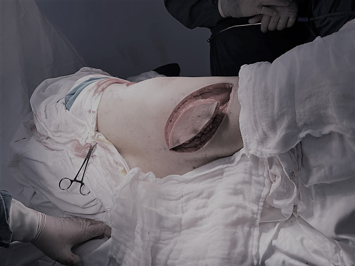 Tái tạo ngực cho bệnh nhân ung thư vú 19 tuổi bằng vạt cơ lưng Tai tao nguc cho benh nhan ung thu vu 19 tuoi bang vat co lung