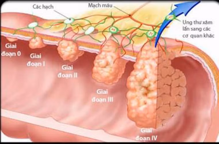  Ở giai đoạn 0, bệnh nhân không có nhiều biểu hiện bất thường, rất khó được phát hiện. Tại thời điểm này, tế bào ung thư mới xuất hiện ở niêm mạc bên trong, còn gọi là ungthư biểu mô. 