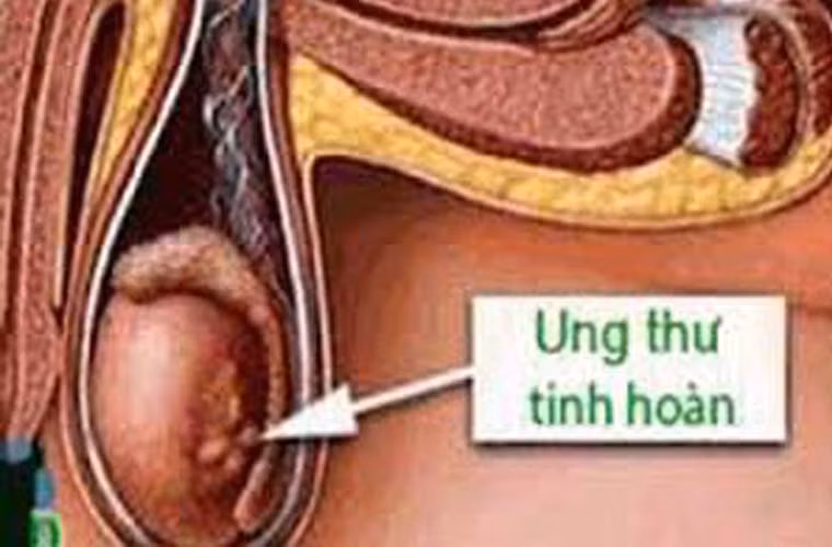  Tinh hoàn một trong những tuyến sinh dục có nhiệm vụ sản xuất và chứa tinh dịch, các hormone nam có chức năng kiểm soát sự phát triển của cơ quan sinh sản và đặc tính nam. Tế bào ung thư có thể xuất hiện ở một hoặc cả hai bên tinh hoàn. 