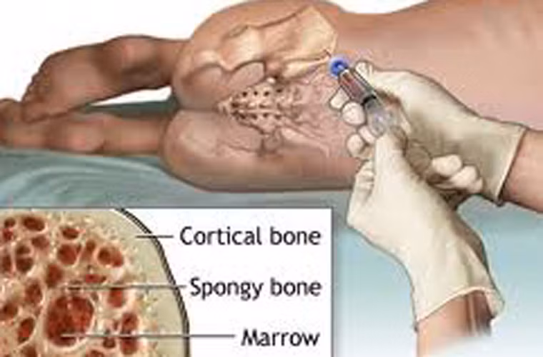 Bi quyet luyen tap tot nhat cho benh nhan suy tuy