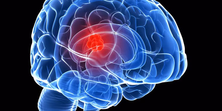  Giống như nhiều loại ung thư khác, việc phát hiện sớm góp phần đáng kể trong việc nâng cao hiệu quả quá trình điều trị. Tùy từng giai đoạn, bệnh có biểu hiện khác nhau. Chính vì lý do này, không nên bỏ qua bất kỳ dấu hiệu bất thường nào của cơ thể. 